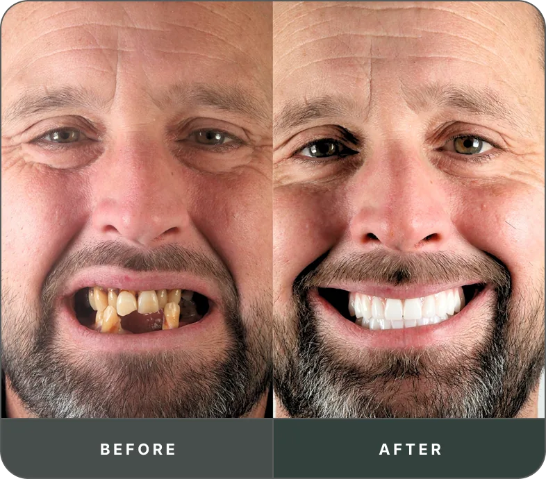Before and after dental implant treatment — Implant 360 patient