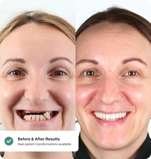 Before and after dental implant treatment — Implant 360 patient
