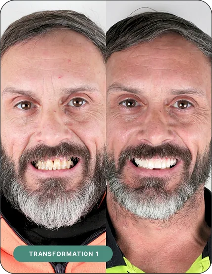 Before and after dental implant treatment — Implant 360 patient