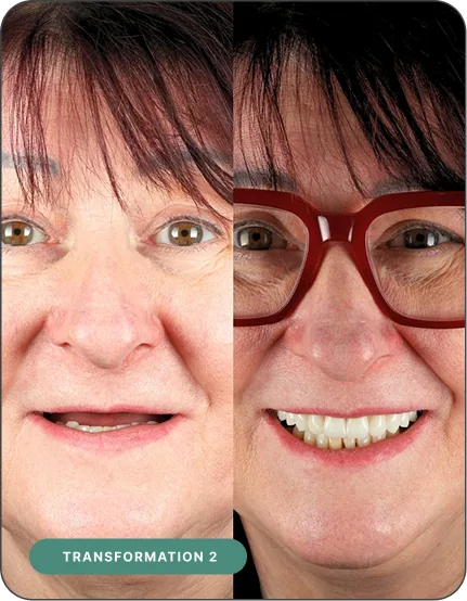 Before and after dental implant treatment — Implant 360 patient