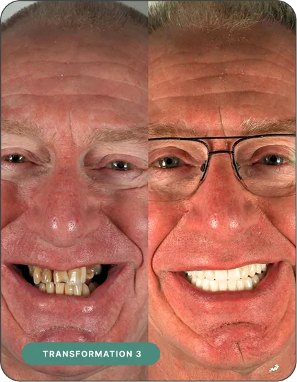 Before and after dental implant treatment — Implant 360 patient
