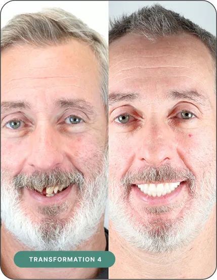 Before and after dental implant treatment — Implant 360 patient